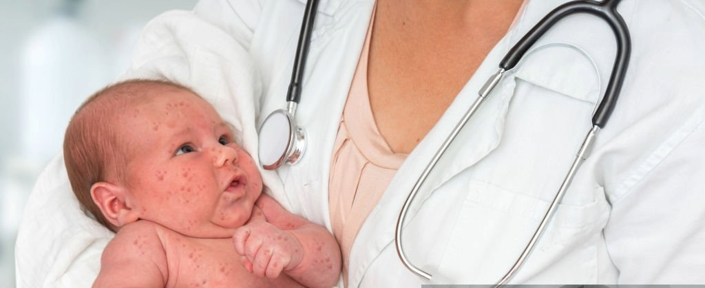 En este momento estás viendo En Chiapas el sarampión se robó la navidad