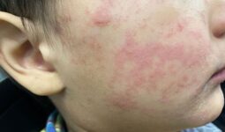 Es necesario vacunarse contra el sarampión