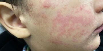 Es necesario vacunarse contra el sarampión