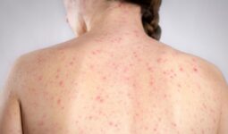 Confirman 5 casos de sarampión en Querétaro