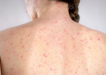 Confirman 5 casos de sarampión en Querétaro