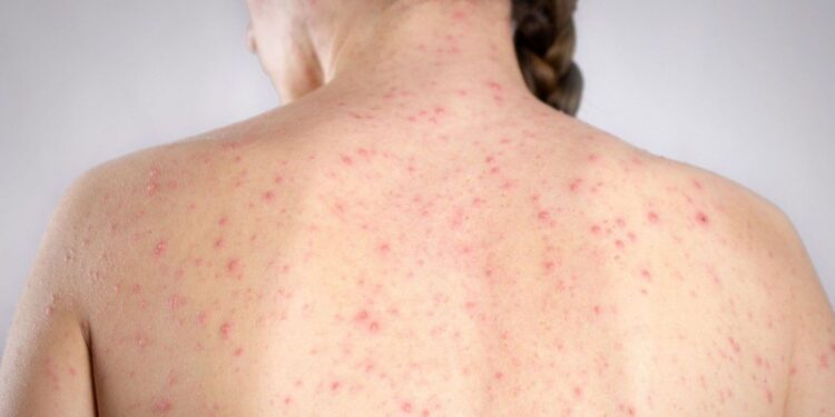 Confirman 5 casos de sarampión en Querétaro