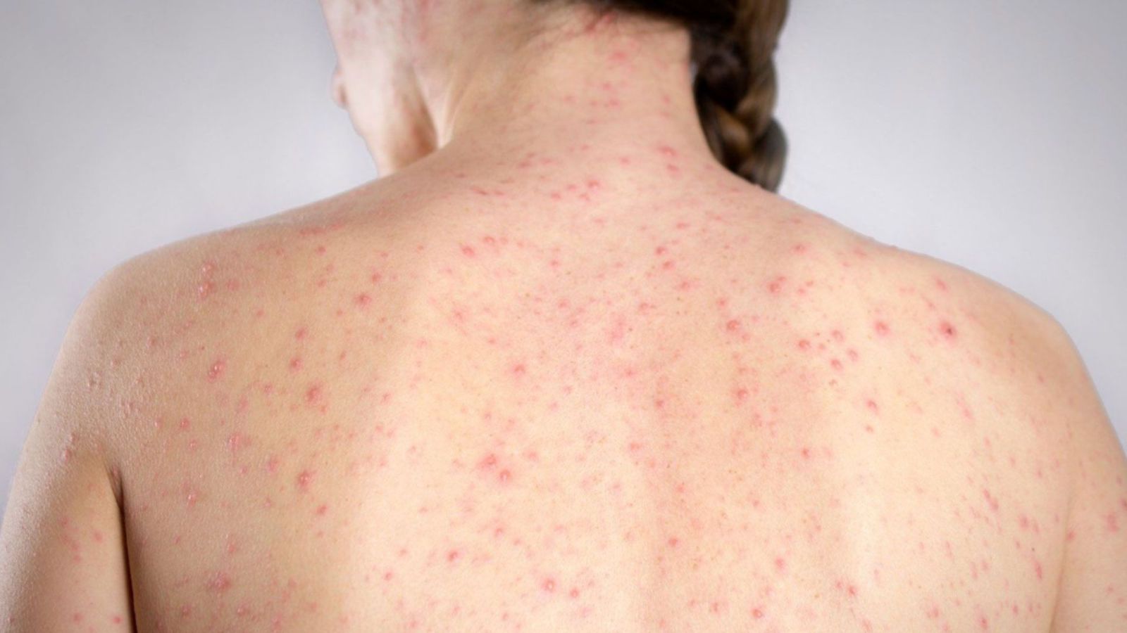 En este momento estás viendo Confirman 5 casos de sarampión en Querétaro